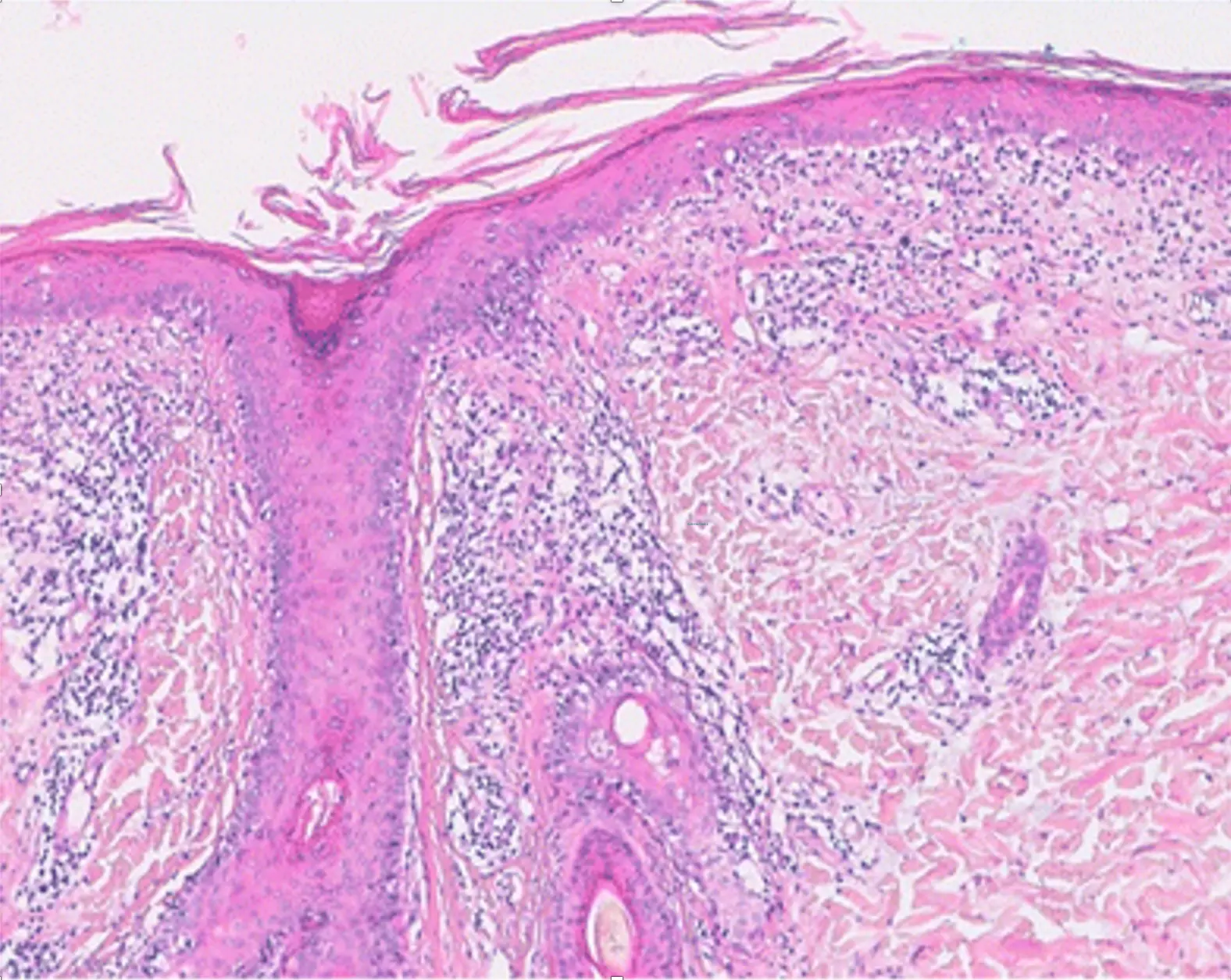 Cutaneous lupus - Lupus CME